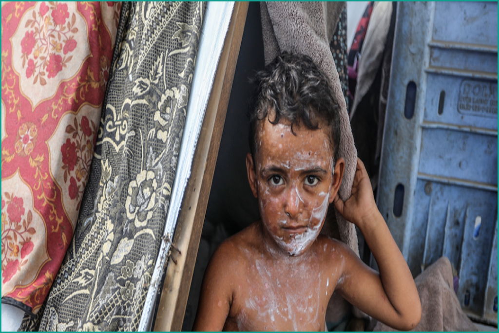 Chickenpox Cases Surge Among Displaced Children in Gaza