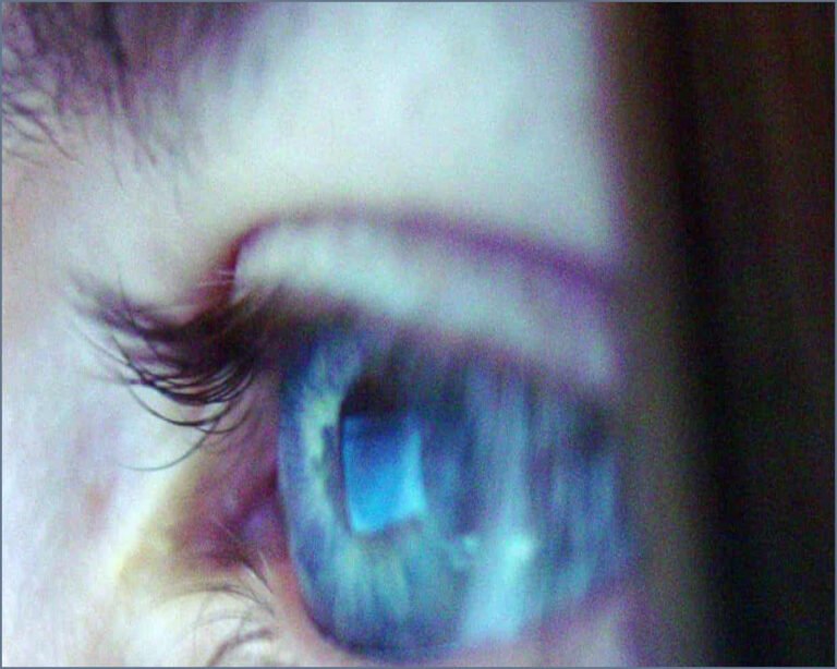 Gene Therapy Safely Restores Partial Sight in Clinical Trial